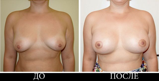 Ирина (пациентка АРТ-Клиник): подтяжка и увеличение груди